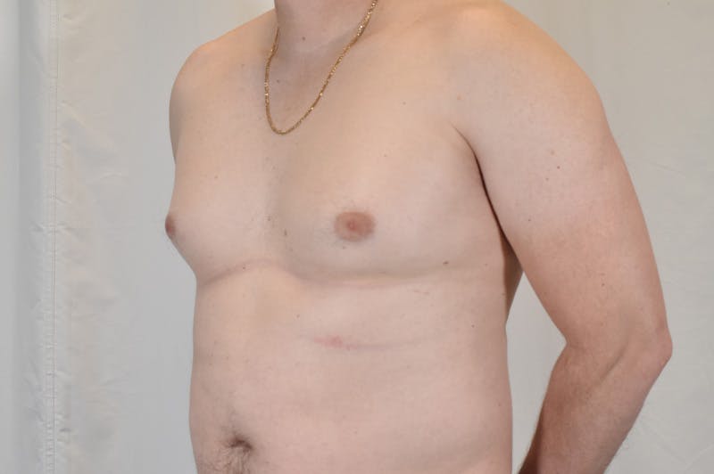 Gynecomastia Before & After Gallery - Patient 265097 - Image 7