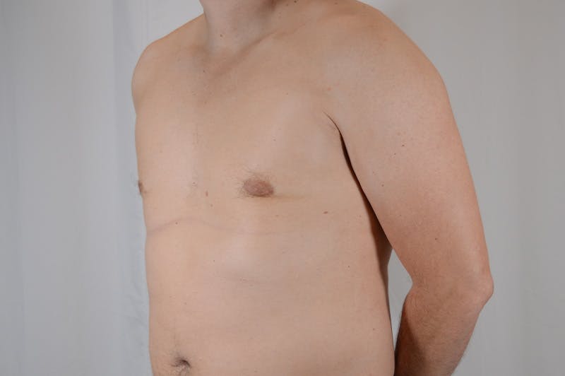Gynecomastia Before & After Gallery - Patient 265097 - Image 8