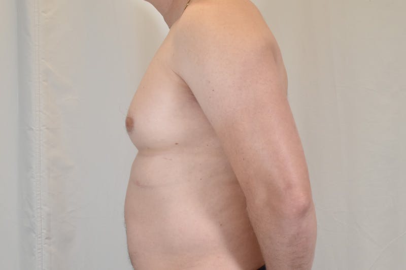 Gynecomastia Before & After Gallery - Patient 265097 - Image 9