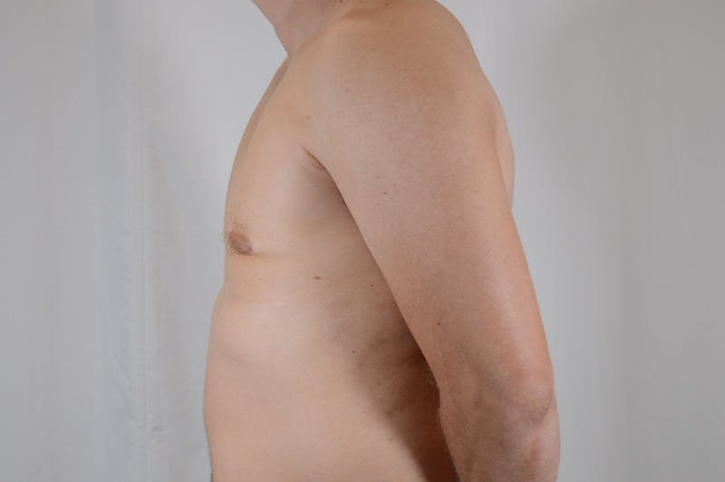 Gynecomastia Before & After Gallery - Patient 265097 - Image 10