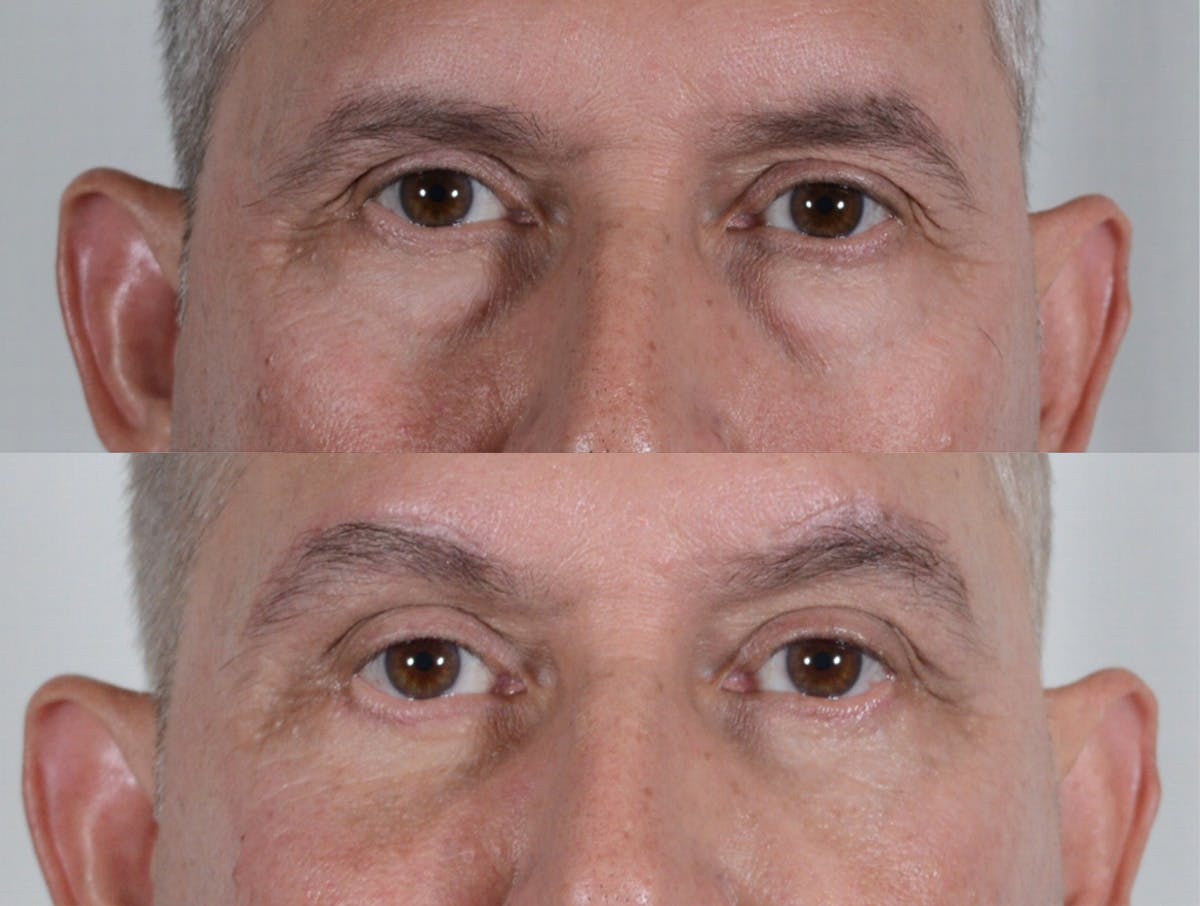 Blepharoplasty Before & After Gallery - Patient 388739 - Image 1