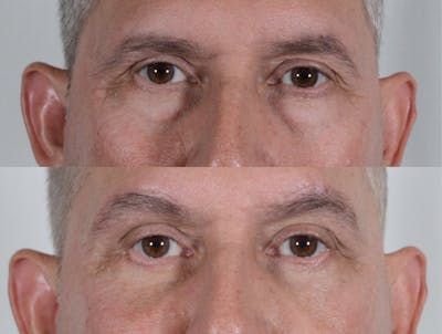 Blepharoplasty Before & After Gallery - Patient 388739 - Image 1