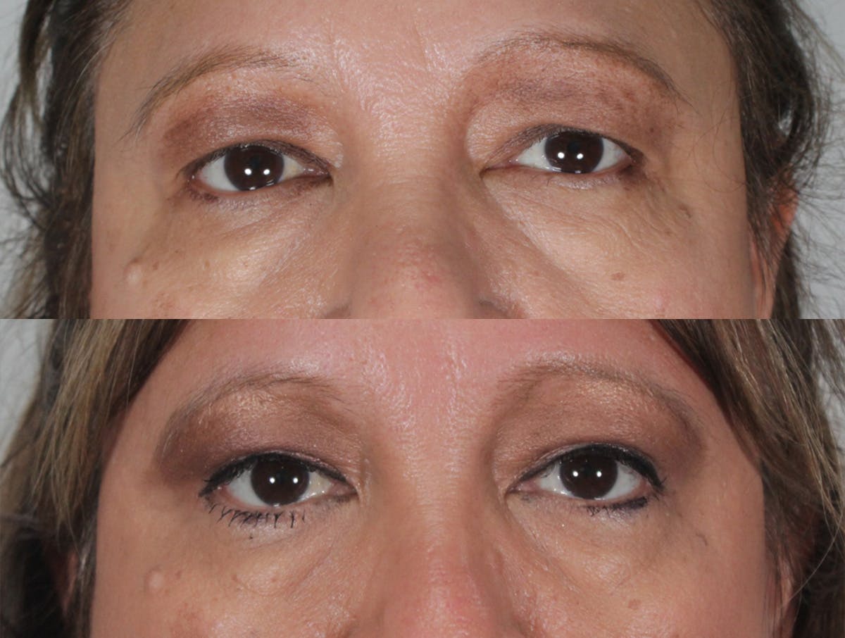 Blepharoplasty Before & After Gallery - Patient 126395 - Image 1