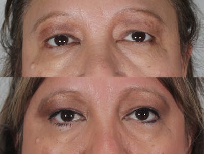 Blepharoplasty Before & After Gallery - Patient 126395 - Image 1