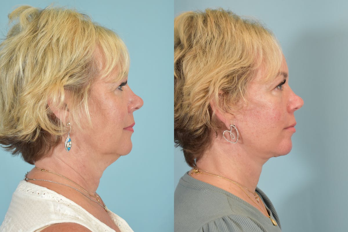 Facelift Before & After Gallery - Patient 101335 - Image 3
