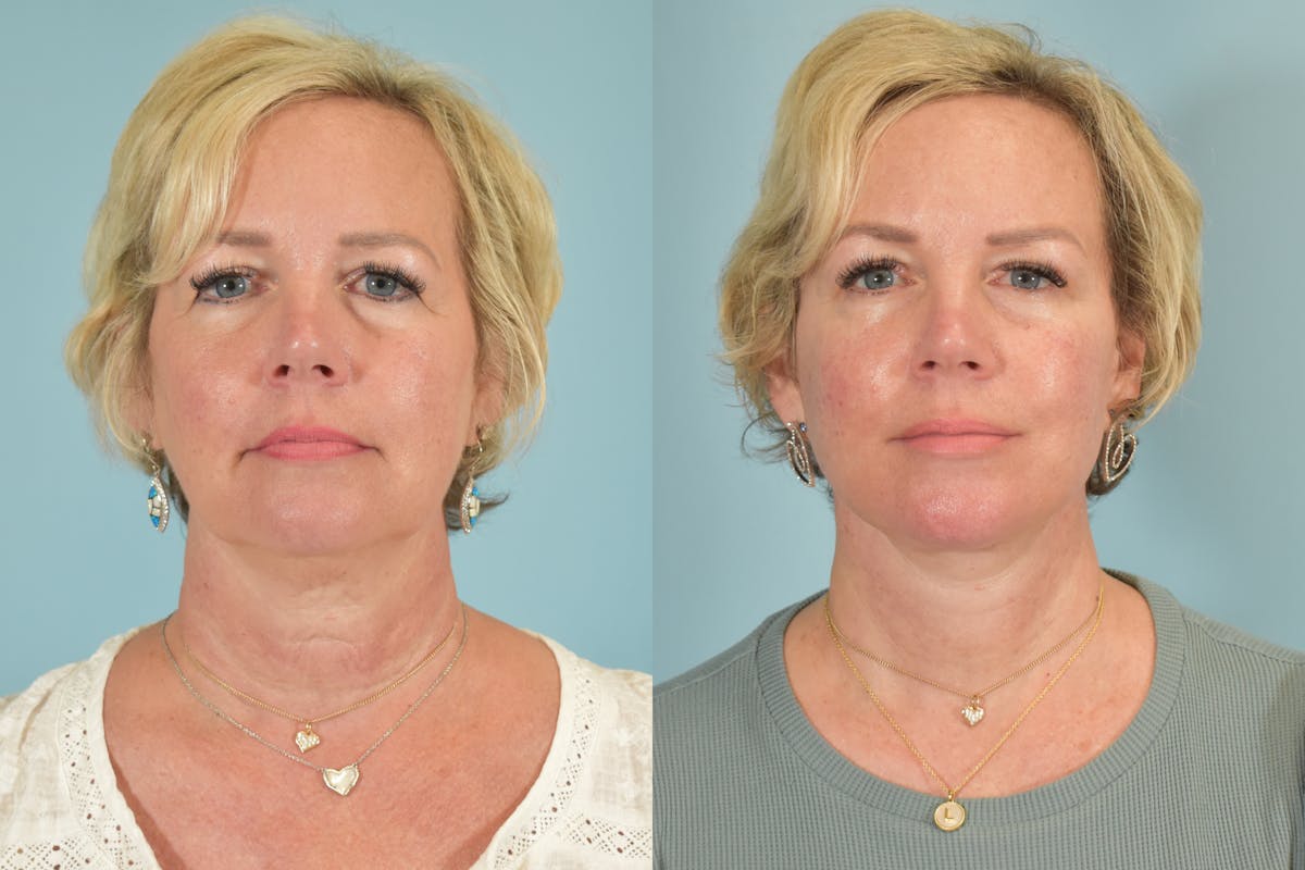 Facelift Before & After Gallery - Patient 101335 - Image 1