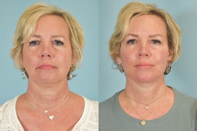 Facelift Before & After Gallery - Patient 101335 - Image 1
