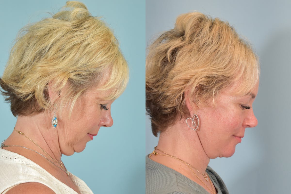 Facelift Before & After Gallery - Patient 101335 - Image 4