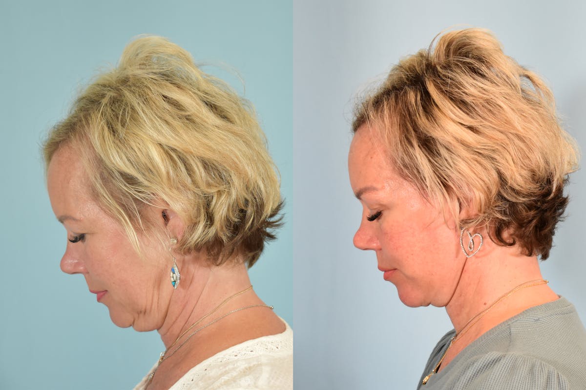 Facelift Before & After Gallery - Patient 101335 - Image 7