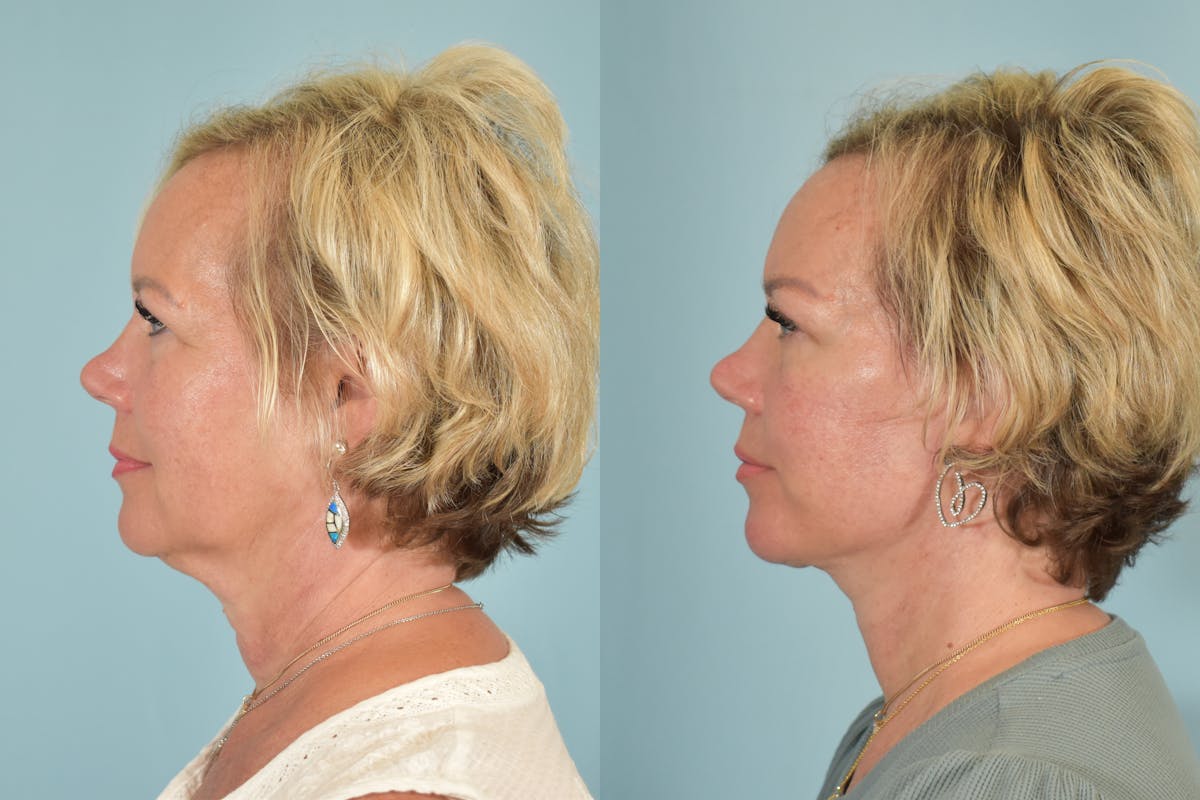 Facelift Before & After Gallery - Patient 101335 - Image 6