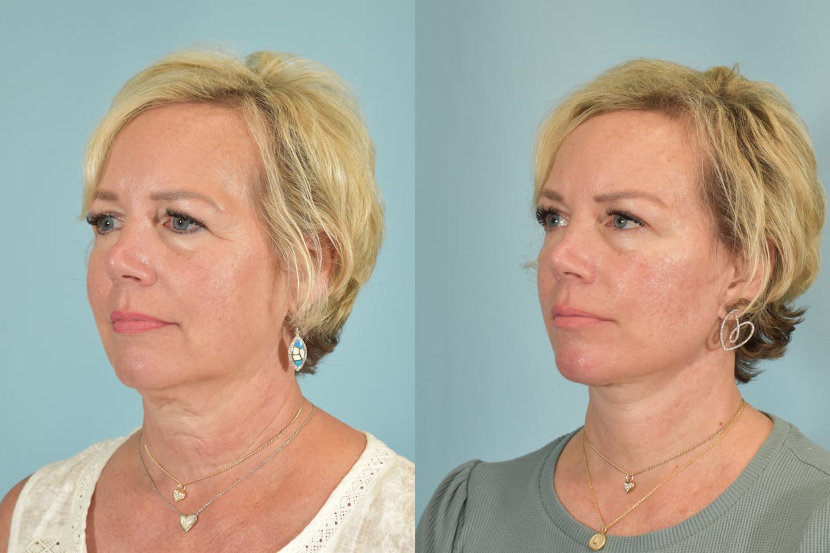 Facelift Before & After Gallery - Patient 101335 - Image 5
