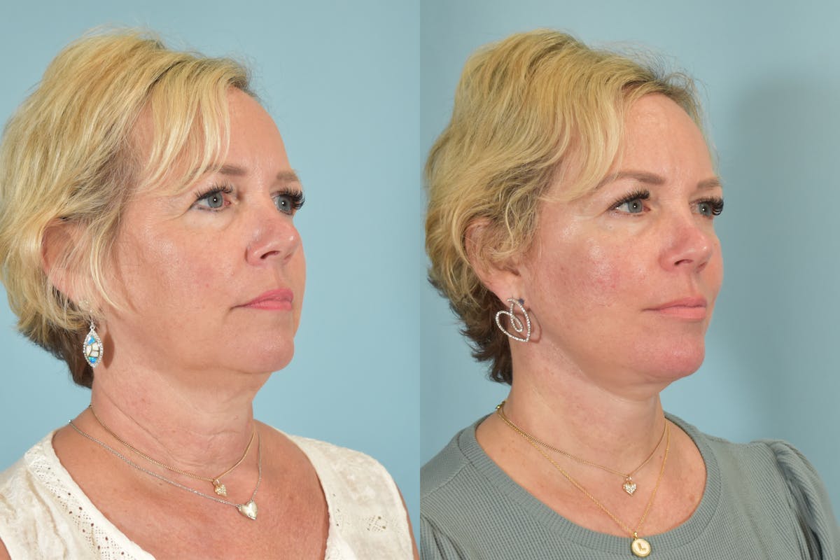 Facelift Before & After Gallery - Patient 101335 - Image 2