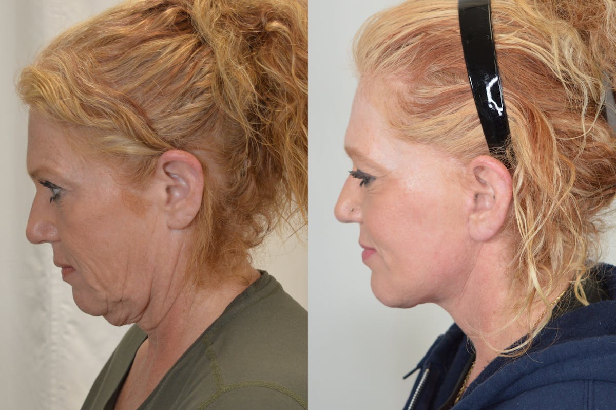 Facelift Before & After Gallery - Patient 124724 - Image 7