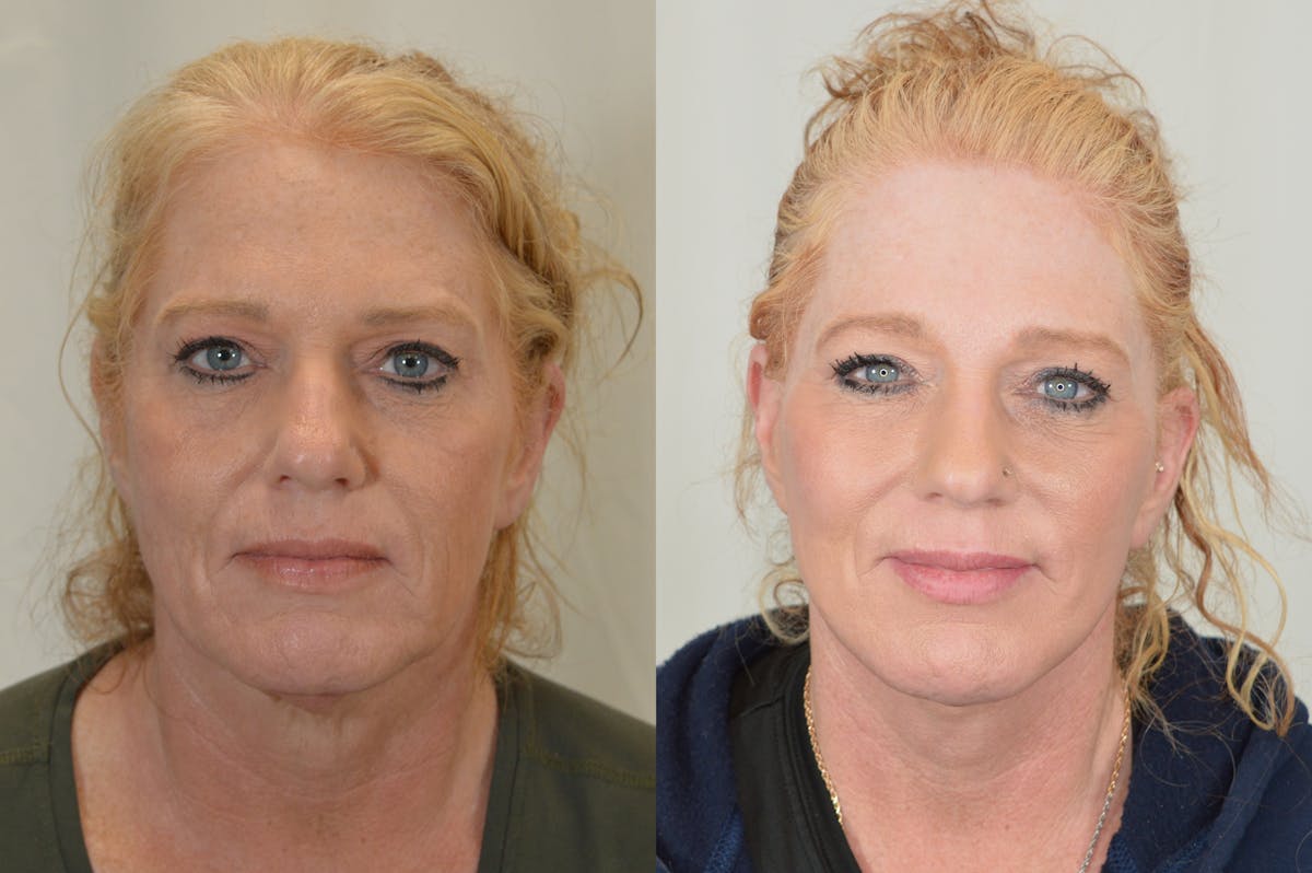Facelift Before & After Gallery - Patient 124724 - Image 1