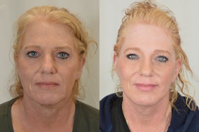 Facelift Before & After Gallery - Patient 124724 - Image 1