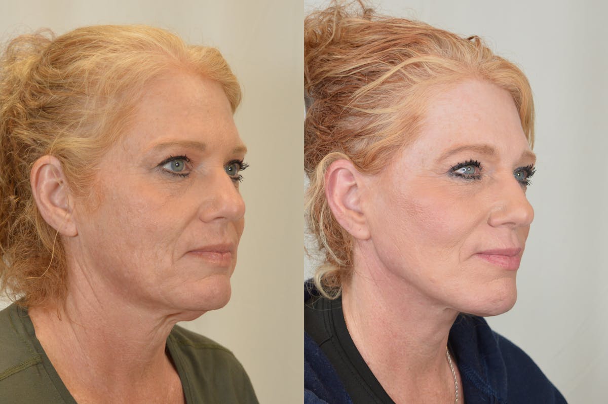 Facelift Before & After Gallery - Patient 124724 - Image 2