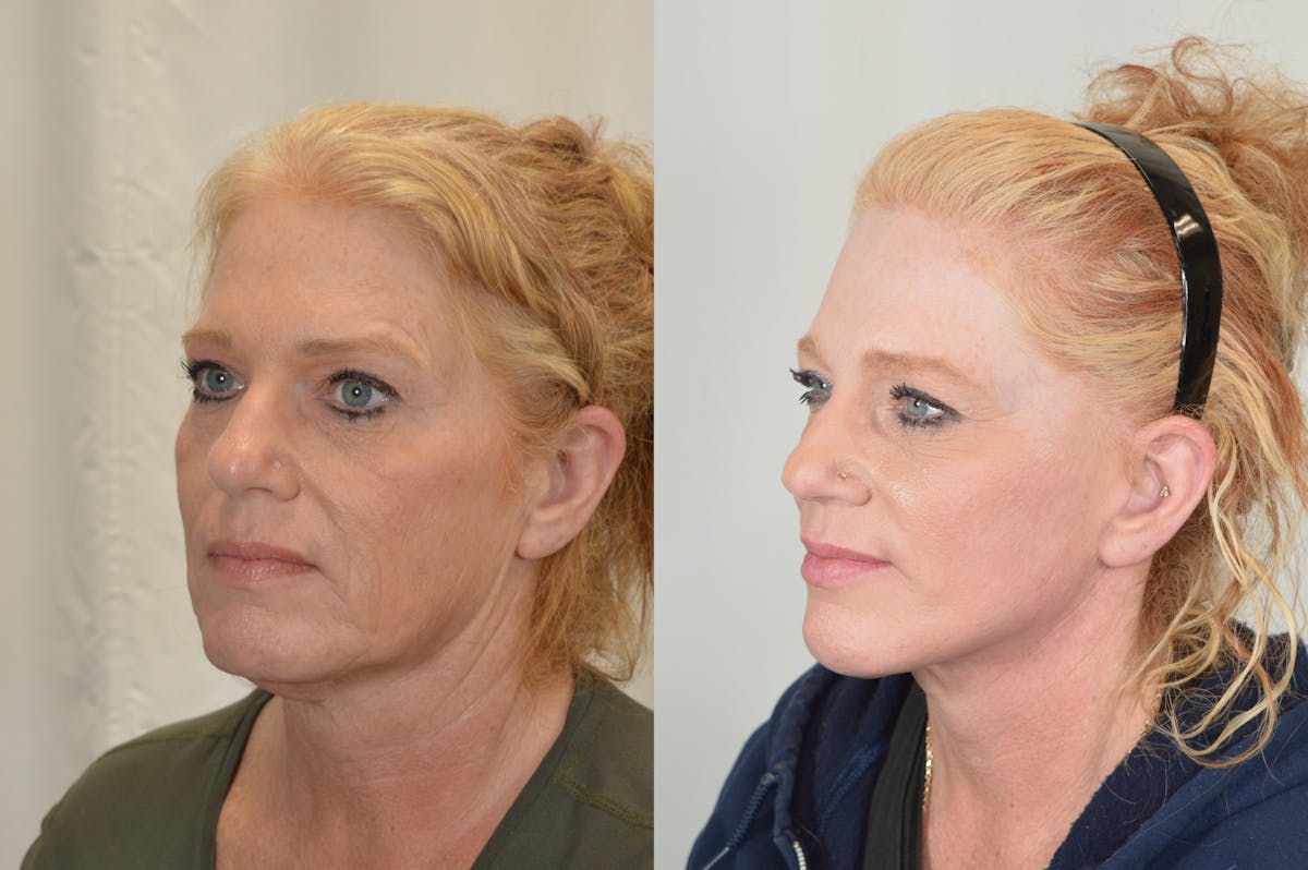 Facelift Before & After Gallery - Patient 124724 - Image 5