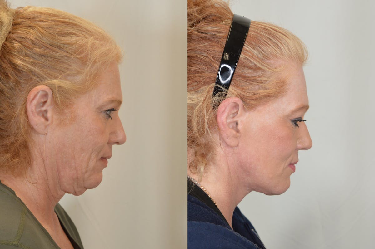 Facelift Before & After Gallery - Patient 124724 - Image 4