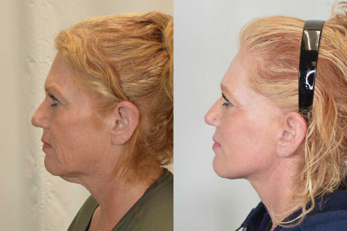 Facelift Before & After Gallery - Patient 124724 - Image 6
