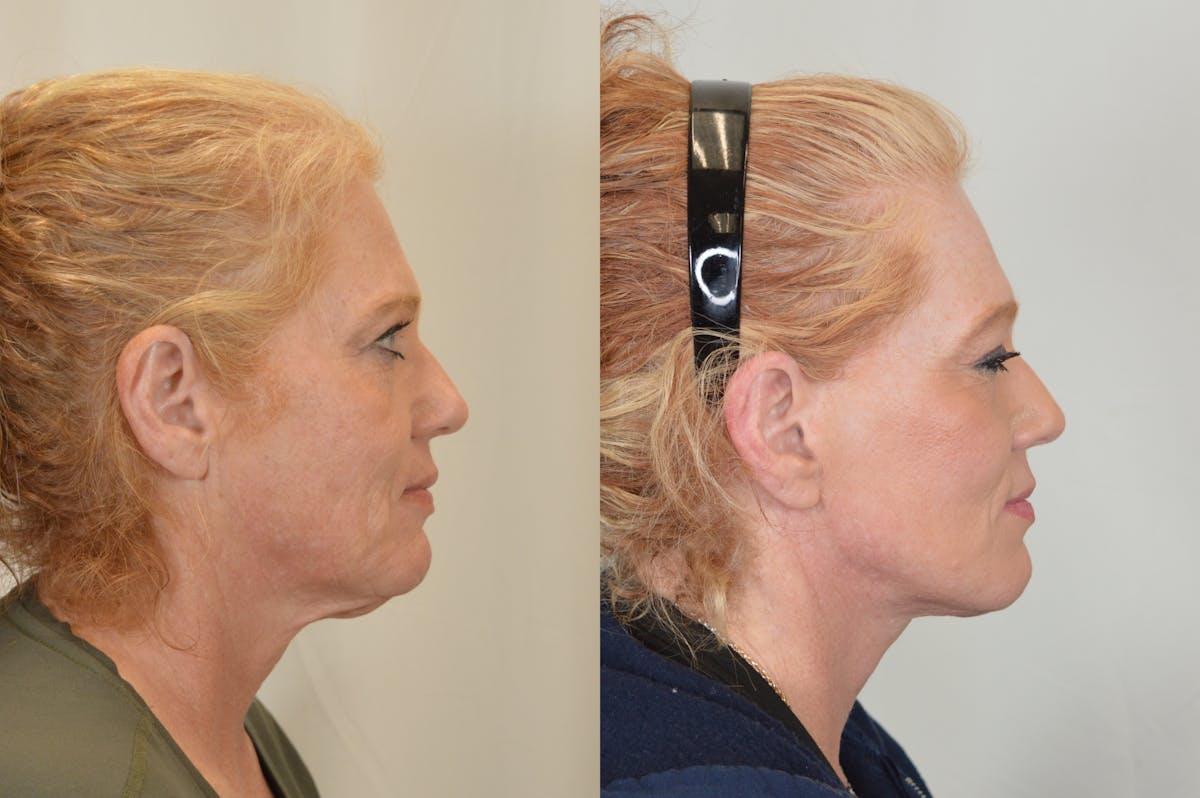 Facelift Before & After Gallery - Patient 124724 - Image 3