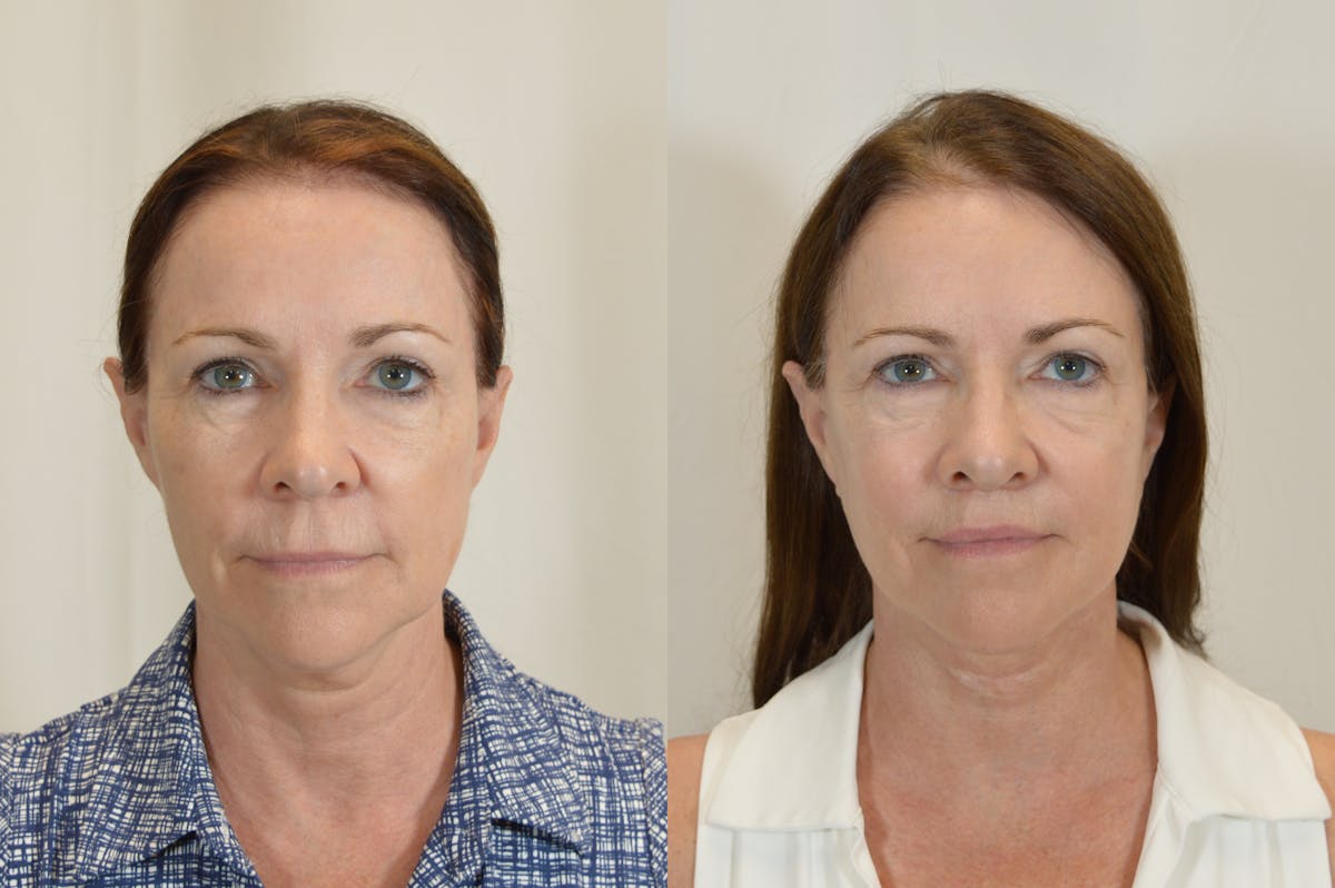 Facelift Before & After Gallery - Patient 246551 - Image 1
