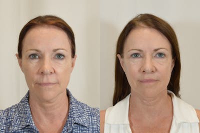 Facelift Before & After Gallery - Patient 246551 - Image 1