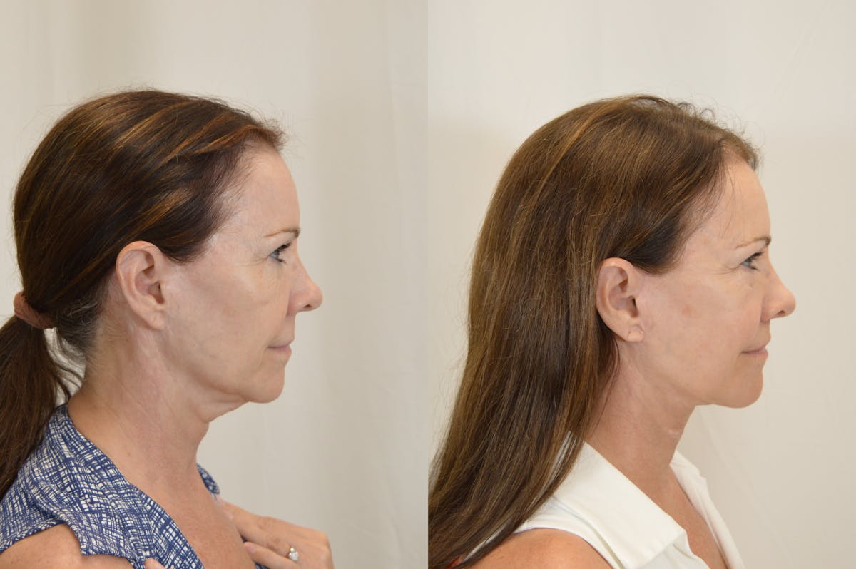 Facelift Before & After Gallery - Patient 246551 - Image 3