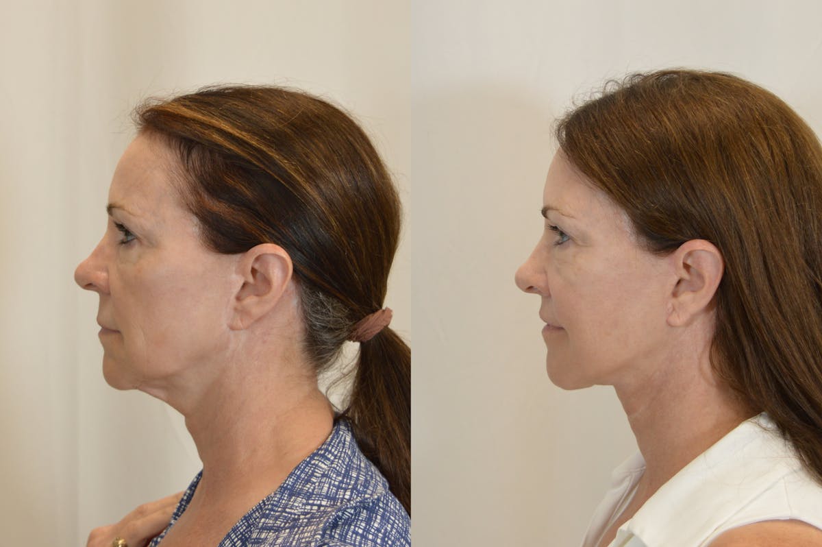 Facelift Before & After Gallery - Patient 246551 - Image 5