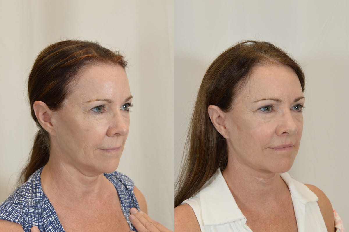 Facelift Before & After Gallery - Patient 246551 - Image 2