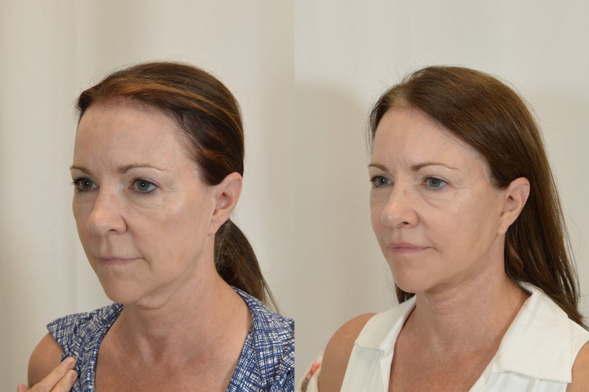 Facelift Before & After Gallery - Patient 246551 - Image 4