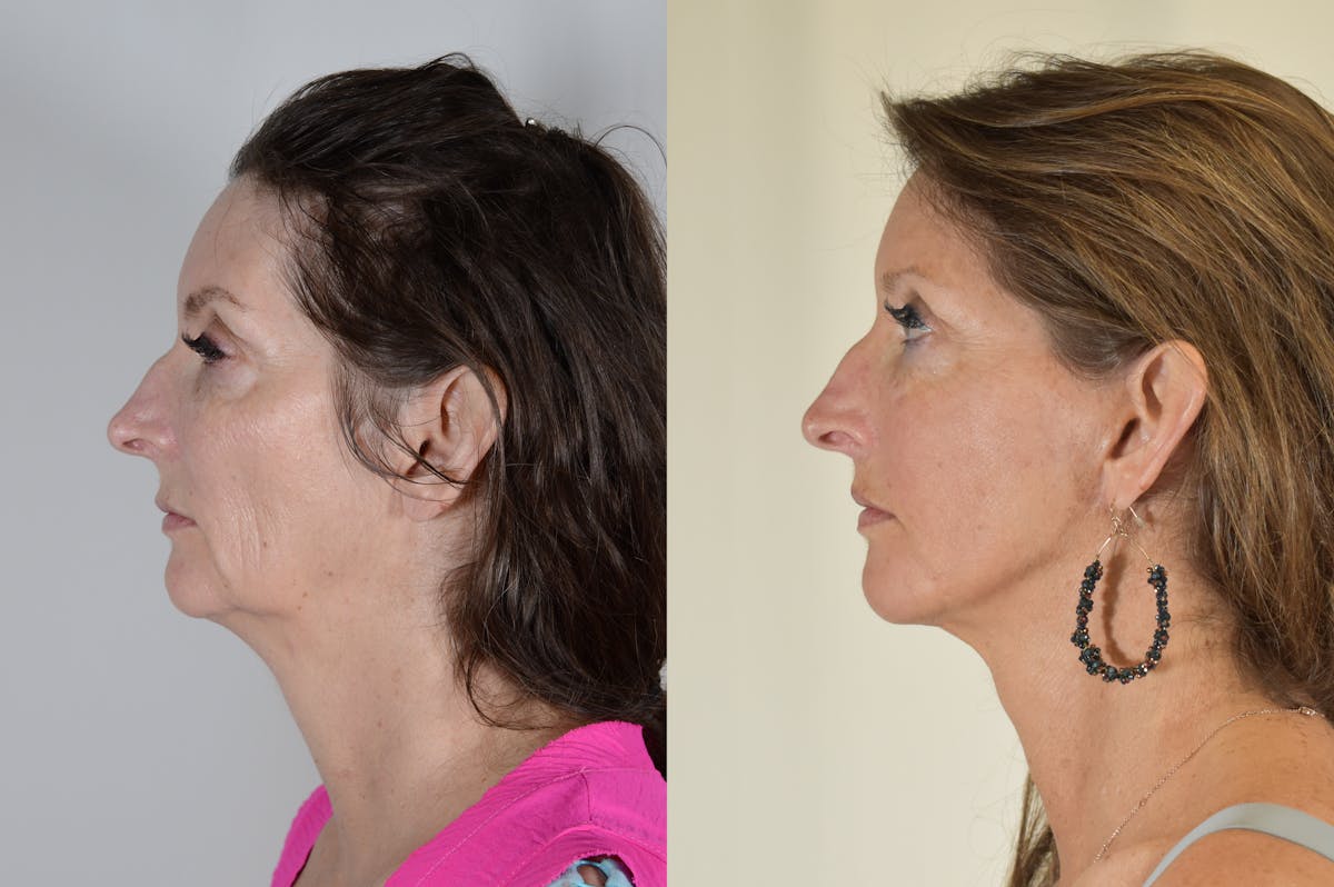 Facelift Before & After Gallery - Patient 854927 - Image 2