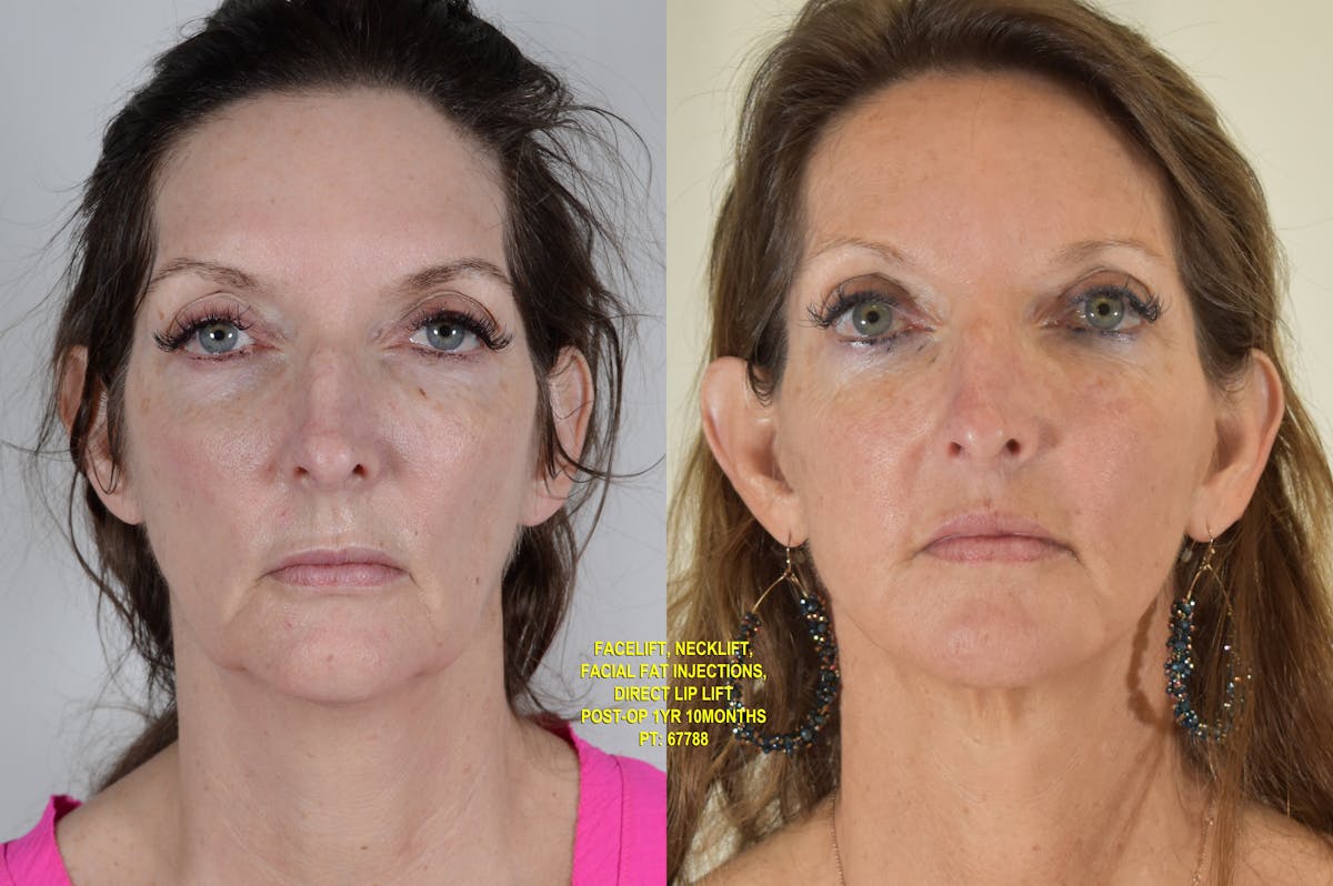Facelift Before & After Gallery - Patient 854927 - Image 1