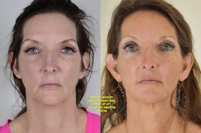 Facelift Before & After Gallery - Patient 854927 - Image 1