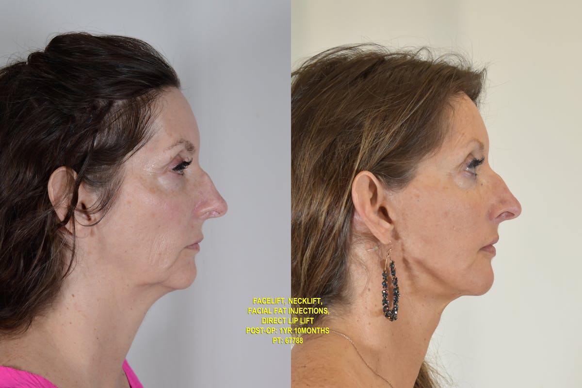 Facelift Before & After Gallery - Patient 854927 - Image 3