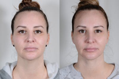 Facelift Before & After Gallery - Patient 315011 - Image 1