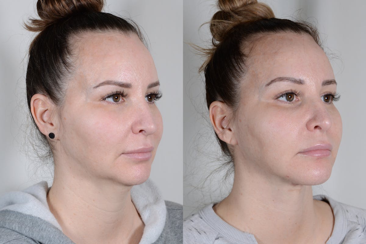 Facelift Before & After Gallery - Patient 315011 - Image 2
