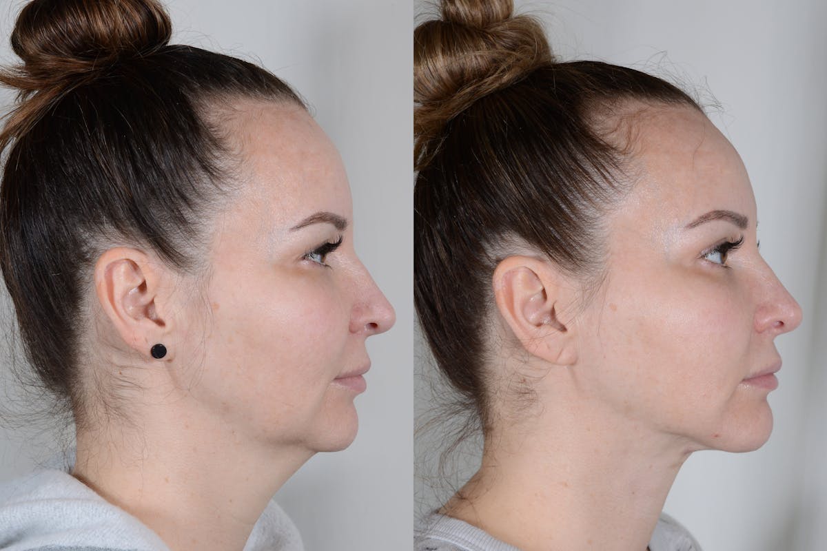 Facelift Before & After Gallery - Patient 315011 - Image 3