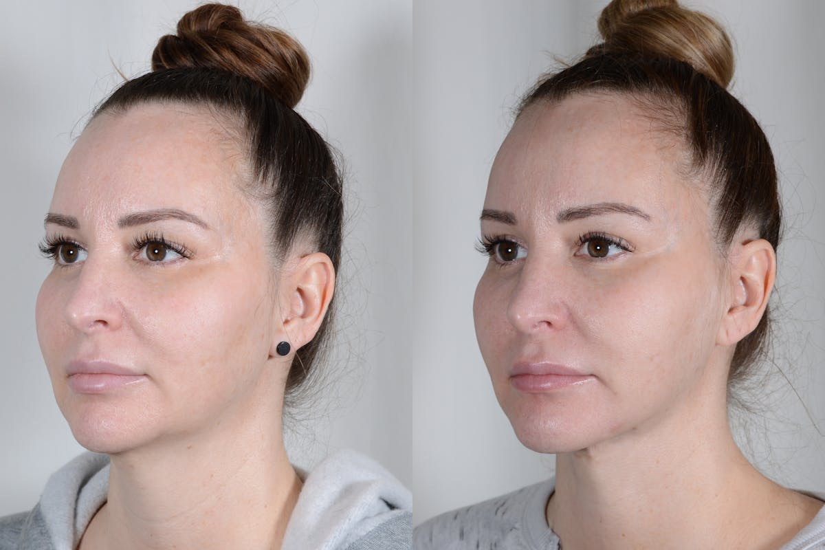 Facelift Before & After Gallery - Patient 315011 - Image 5