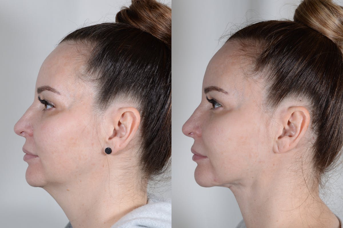 Facelift Before & After Gallery - Patient 315011 - Image 6