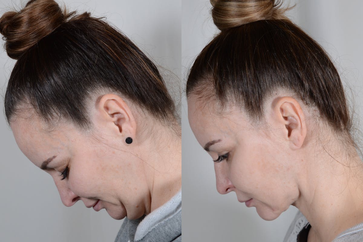 Facelift Before & After Gallery - Patient 315011 - Image 7