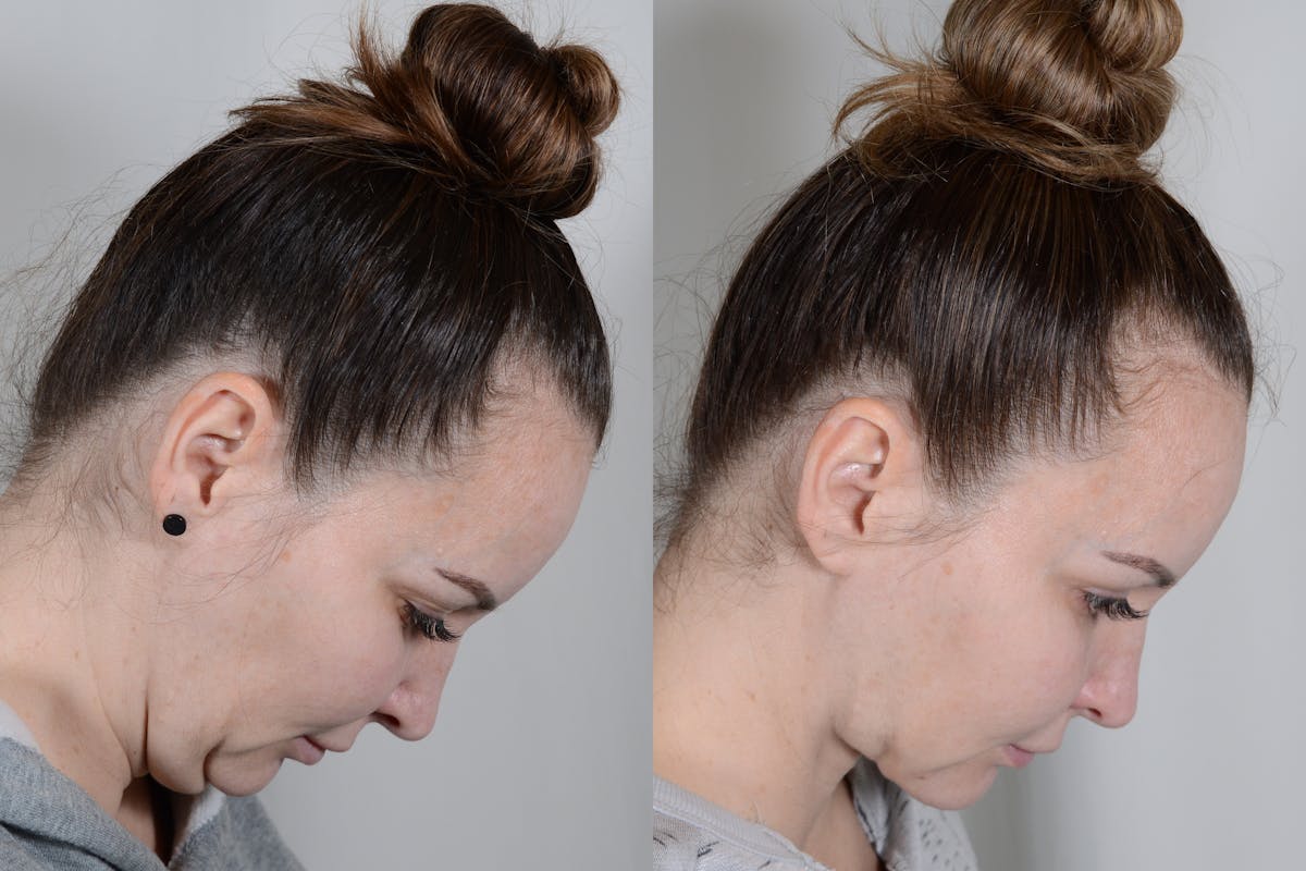 Facelift Before & After Gallery - Patient 315011 - Image 4