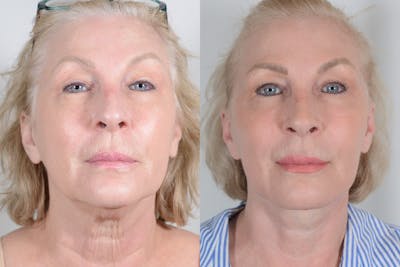 Facelift Before & After Gallery - Patient 107253 - Image 1