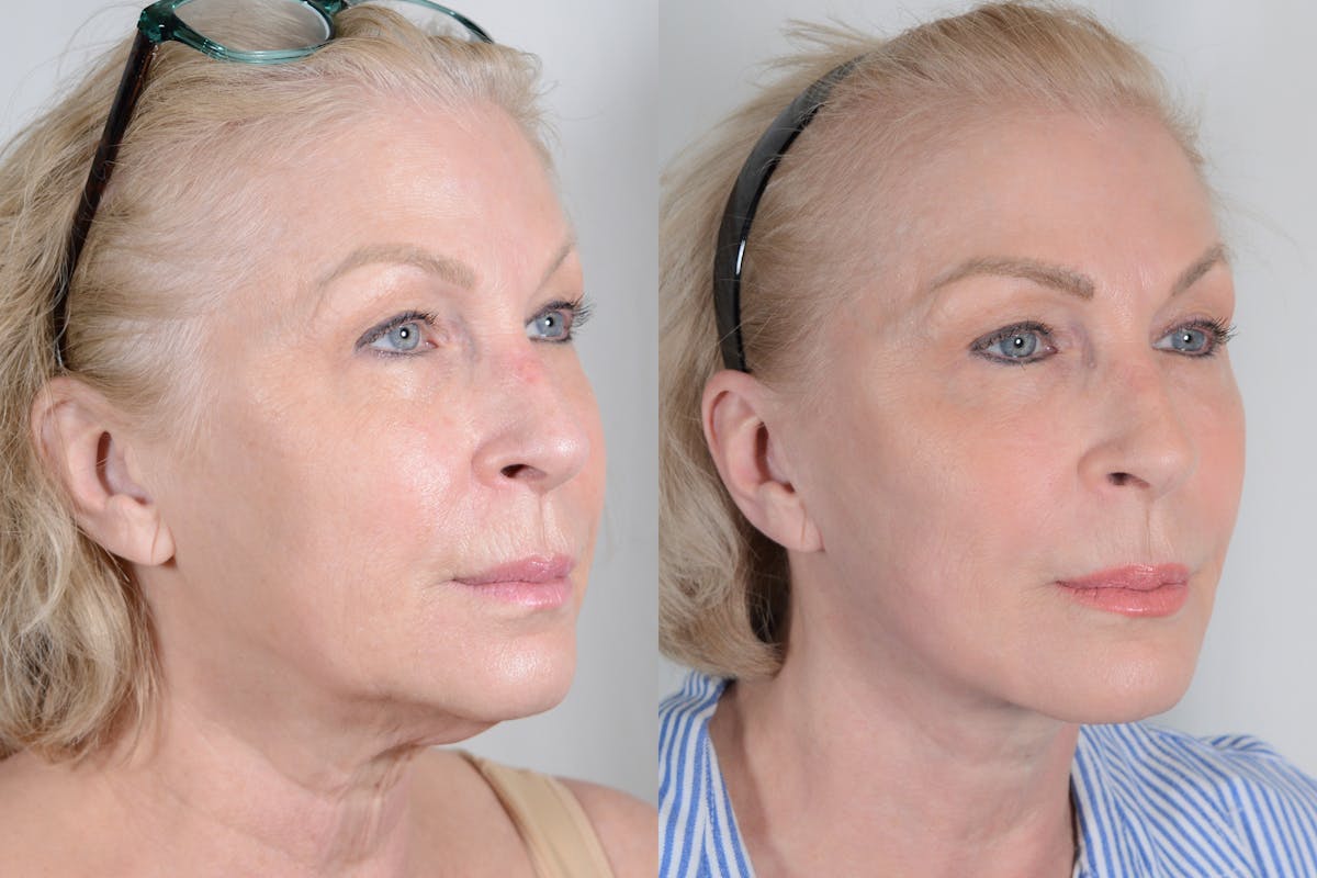 Facelift Before & After Gallery - Patient 107253 - Image 2