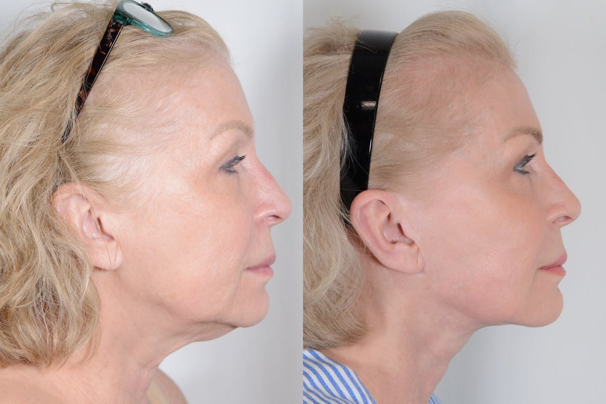 Facelift Before & After Gallery - Patient 107253 - Image 3