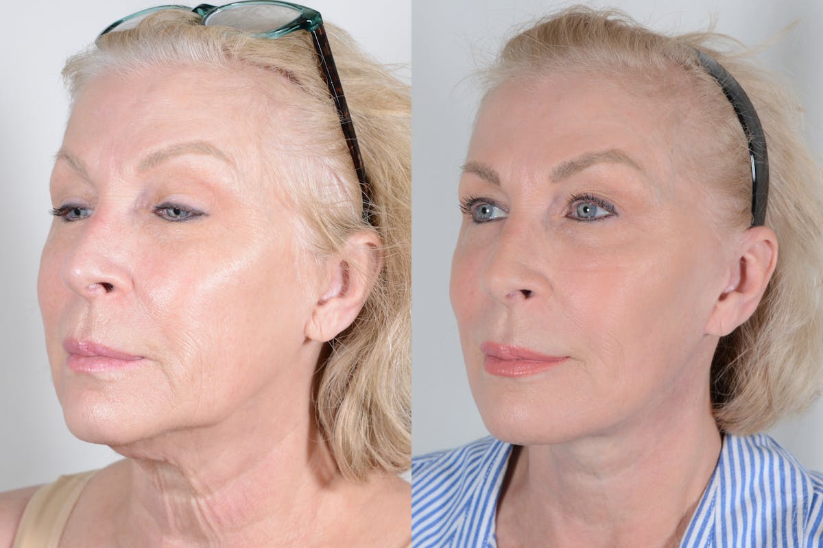 Facelift Before & After Gallery - Patient 107253 - Image 4
