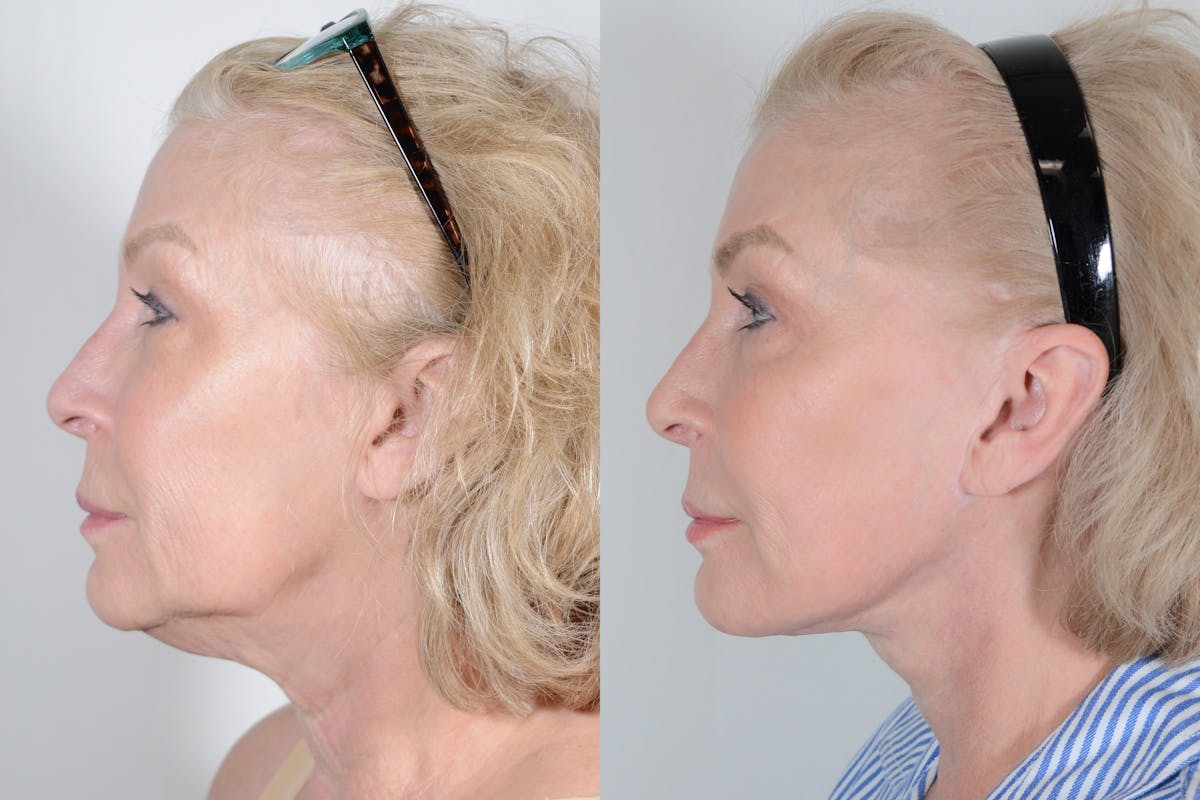Facelift Before & After Gallery - Patient 107253 - Image 5