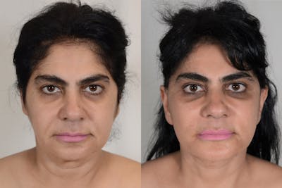 Facelift Before & After Gallery - Patient 206875 - Image 1