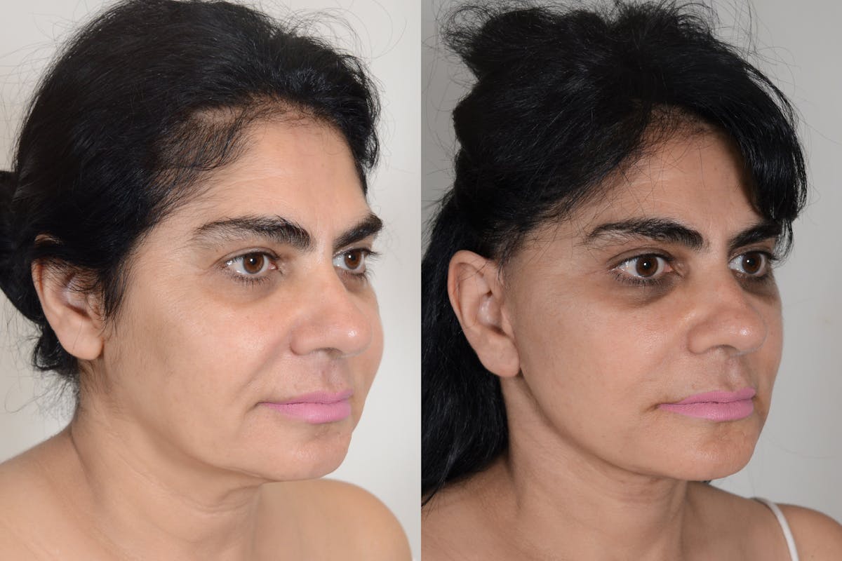 Facelift Before & After Gallery - Patient 206875 - Image 2
