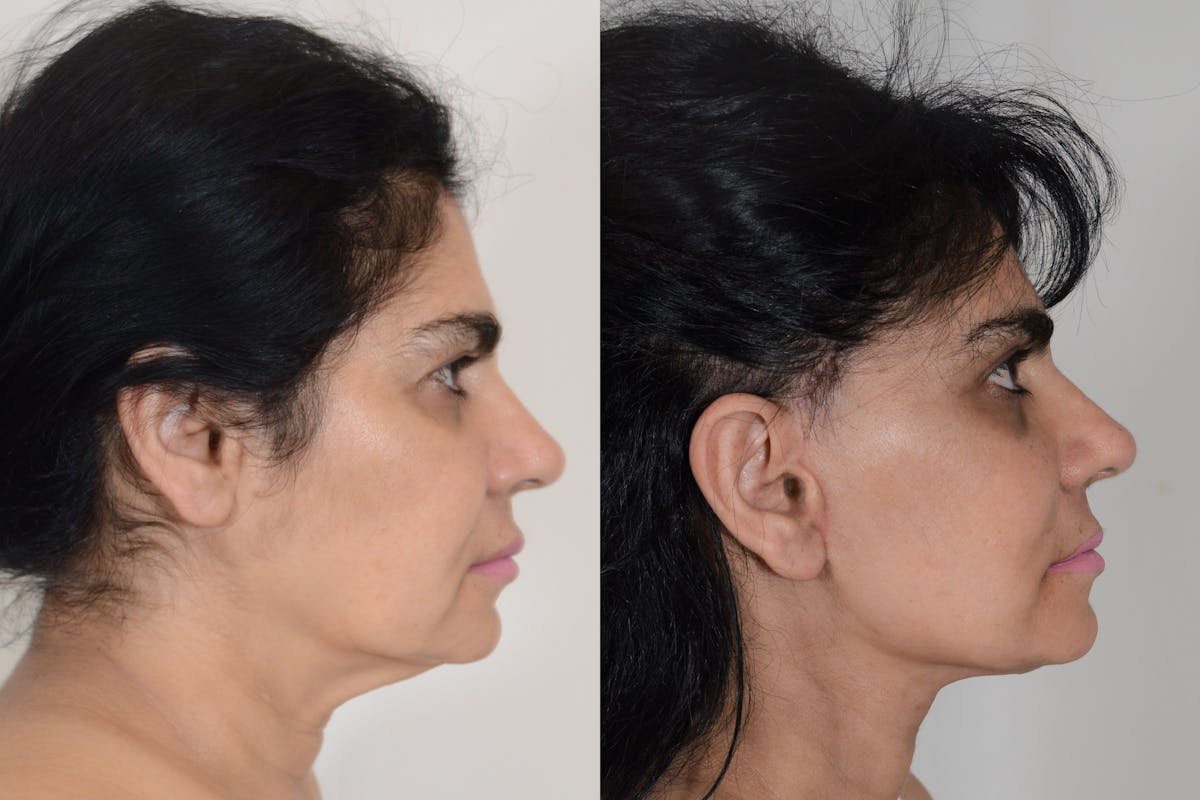 Facelift Before & After Gallery - Patient 206875 - Image 3