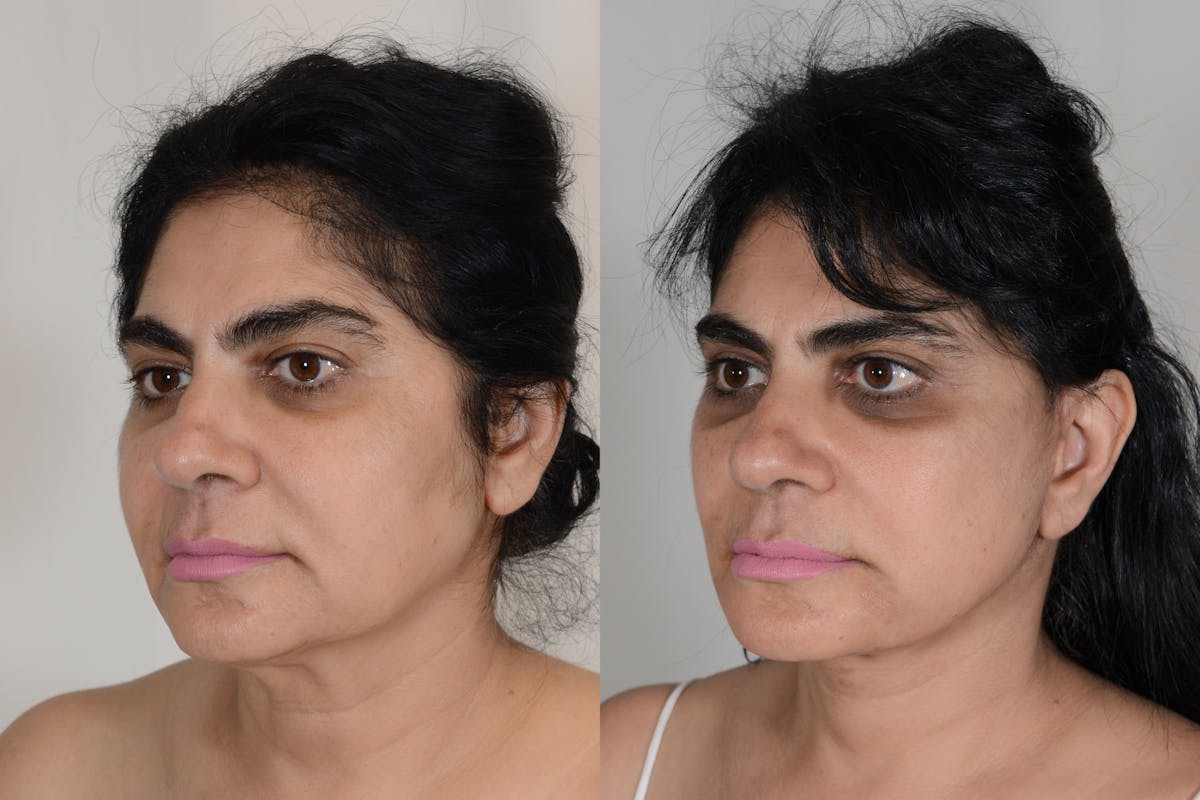 Facelift Before & After Gallery - Patient 206875 - Image 4